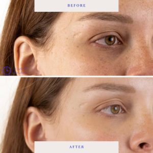 BioRepublic SkinCare Lost Baggage Under Eye Masks - 3pk: Moisturizing, Deep Hydration, Contains Hyaluronic Acid, Sensitive Skin